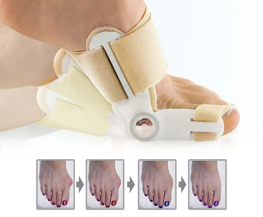 Hallux Valgus Teen Corrector - Verhelpt Pijn Bij Scheefstand Van De Grote Teen!